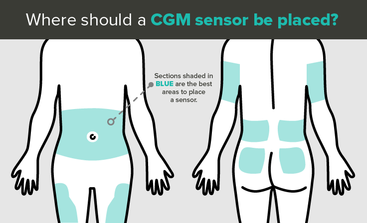 Diagram of common areas to place a CGM sensor - abdomen, tricep, buttocks, thigh and lower back